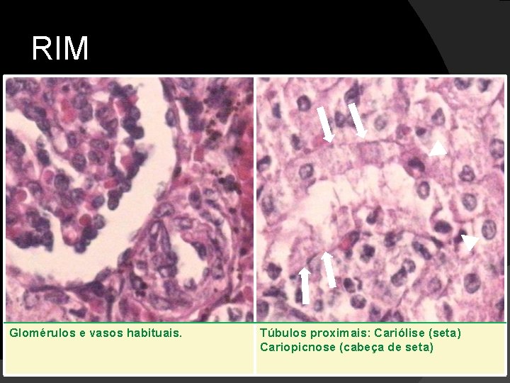 RIM Glomérulos e vasos habituais. Túbulos proximais: Cariólise (seta) Cariopicnose (cabeça de seta) 