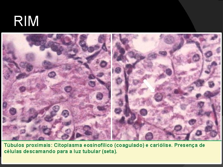 RIM Túbulos proximais: Citoplasma eosinofílico (coagulado) e cariólise. Presença de células descamando para a
