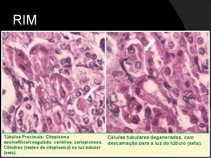 RIM Túbulos Proximais: Citoplasma eosinofílico/coagulado, cariólise, cariopicnose. Cilindros (restos de citoplasma) na luz tubular