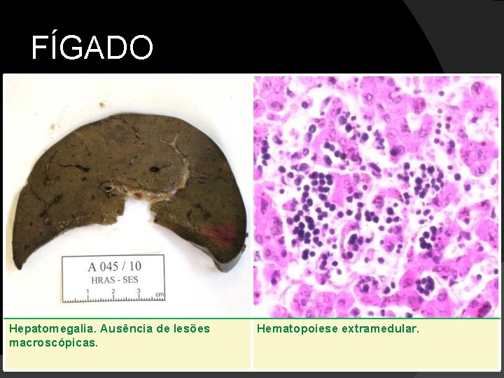 FÍGADO Hepatomegalia. Ausência de lesões macroscópicas. Hematopoiese extramedular. 