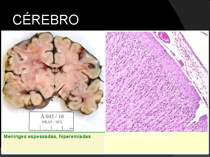 CÉREBRO Meninges espessadas, hiperemiadas Sem Alterações Histológicas. 