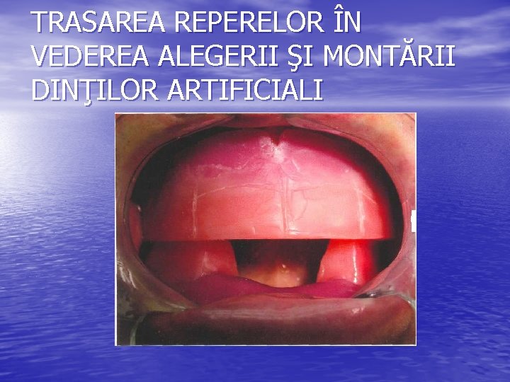 TRASAREA REPERELOR ÎN VEDEREA ALEGERII ŞI MONTĂRII DINŢILOR ARTIFICIALI TRASAREA REPERELOR ÎN VEDEREA ALEGERII ŞI MONTĂRII DINŢILOR ARTIFICIALI