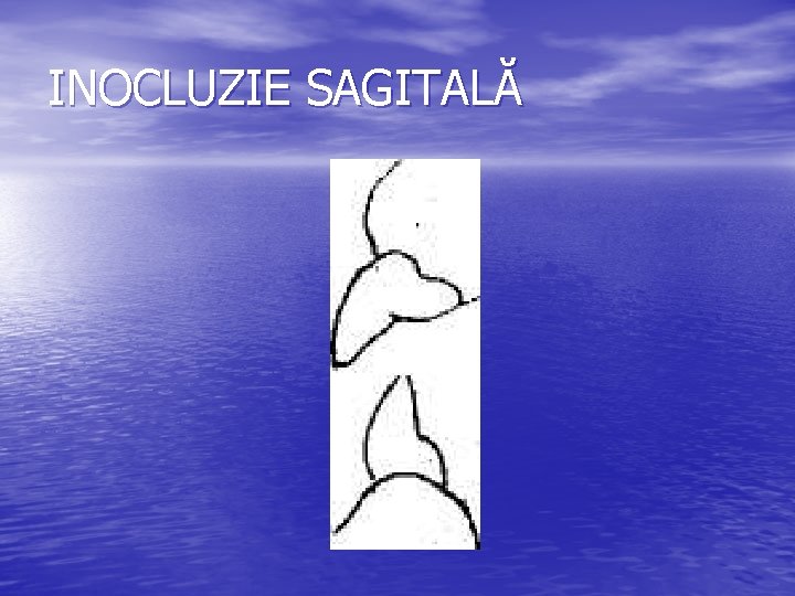 INOCLUZIE SAGITALĂ INOCLUZIE SAGITALĂ