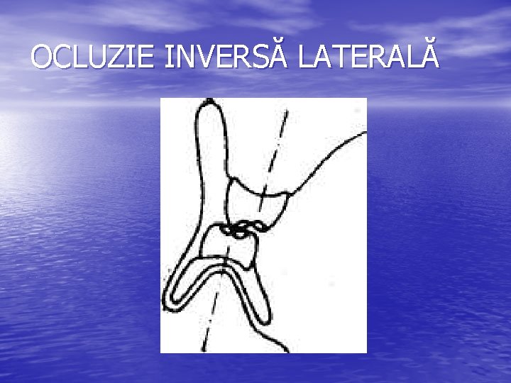 OCLUZIE INVERSĂ LATERALĂ OCLUZIE INVERSĂ LATERALĂ