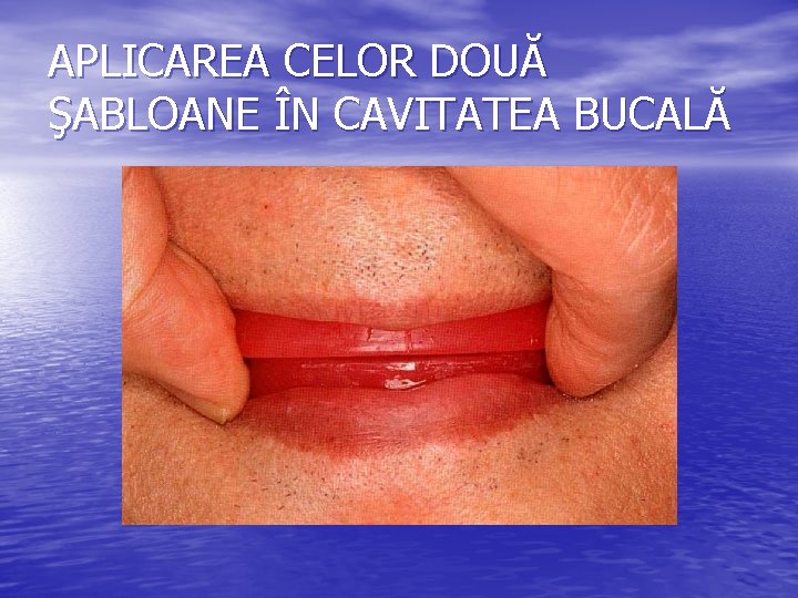 APLICAREA CELOR DOUĂ ŞABLOANE ÎN CAVITATEA BUCALĂ APLICAREA CELOR DOUĂ ŞABLOANE ÎN CAVITATEA BUCALĂ