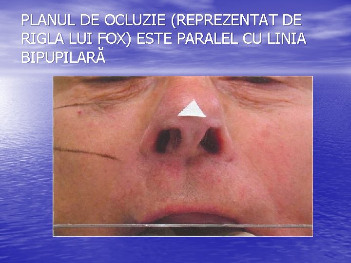 PLANUL DE OCLUZIE (REPREZENTAT DE RIGLA LUI FOX) ESTE PARALEL CU LINIA BIPUPILARĂ PLANUL DE OCLUZIE (REPREZENTAT DE RIGLA LUI FOX) ESTE PARALEL CU LINIA BIPUPILARĂ