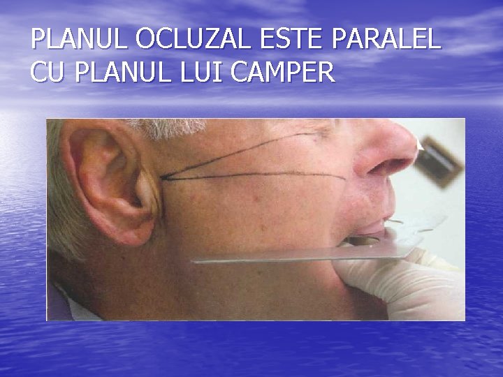 PLANUL OCLUZAL ESTE PARALEL CU PLANUL LUI CAMPER PLANUL OCLUZAL ESTE PARALEL CU PLANUL LUI CAMPER