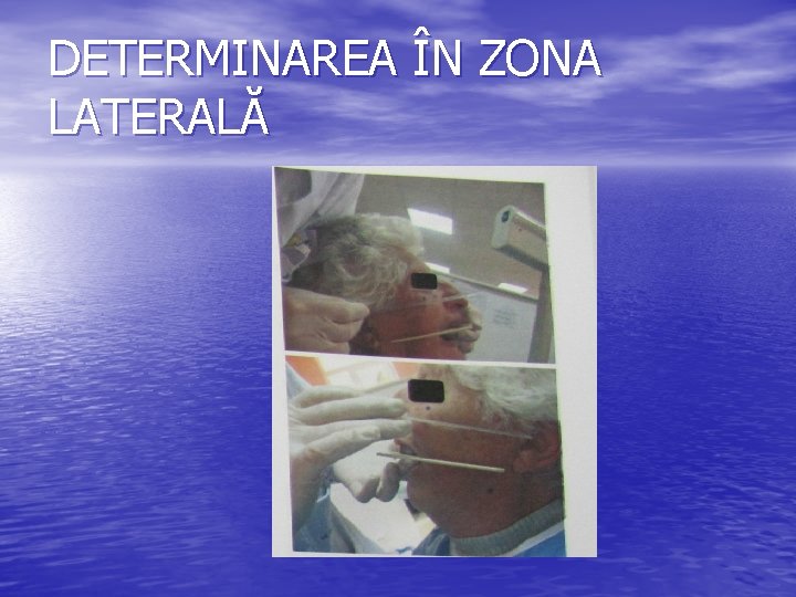 DETERMINAREA ÎN ZONA LATERALĂ DETERMINAREA ÎN ZONA LATERALĂ
