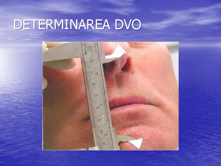 DETERMINAREA DVO DETERMINAREA DVO