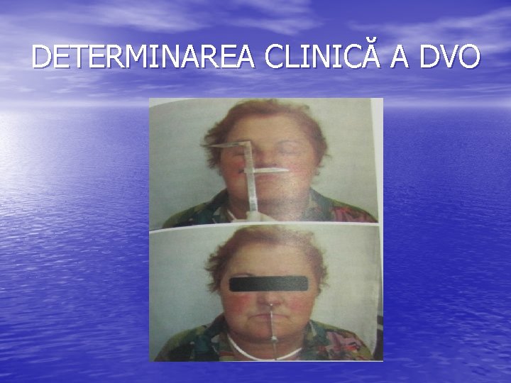 DETERMINAREA CLINICĂ A DVO DETERMINAREA CLINICĂ A DVO