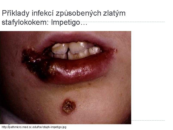 Příklady infekcí způsobených zlatým stafylokokem: Impetigo… http: //pathmicro. med. sc. edu/fox/staph-impetigo. jpg 