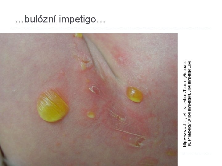 http: //www. adhb. govt. nz/newborn/Teaching. Resource s/Dermatology/Bullous. Impetigo 3. jpg …bulózní impetigo… 