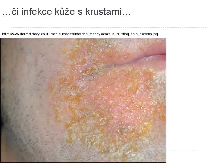 …či infekce kůže s krustami… http: //www. dermatology. co. uk/media/images/Infection_staphylococcus_crusting_chin_closeup. jpg 