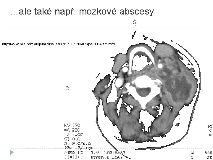 …ale také např. mozkové abscesy http: //www. mja. com. au/public/issues/176_12_170602/got 10354_fm. html 