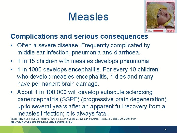 Measles Complications and serious consequences • Often a severe disease. Frequently complicated by middle