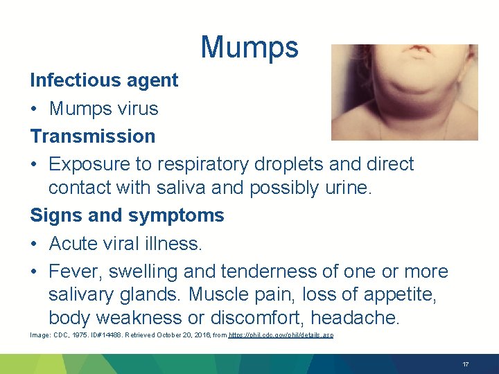 Mumps Infectious agent • Mumps virus Transmission • Exposure to respiratory droplets and direct