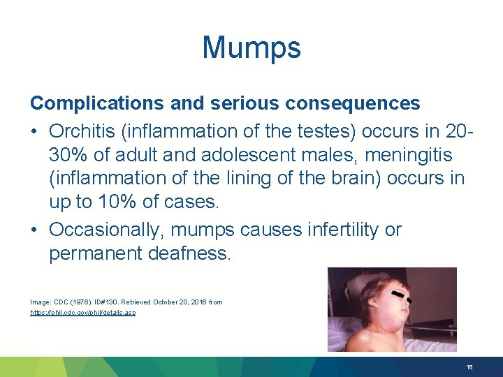 Mumps Complications and serious consequences • Orchitis (inflammation of the testes) occurs in 2030%