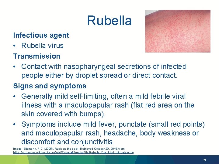 Rubella Infectious agent • Rubella virus Transmission • Contact with nasopharyngeal secretions of infected