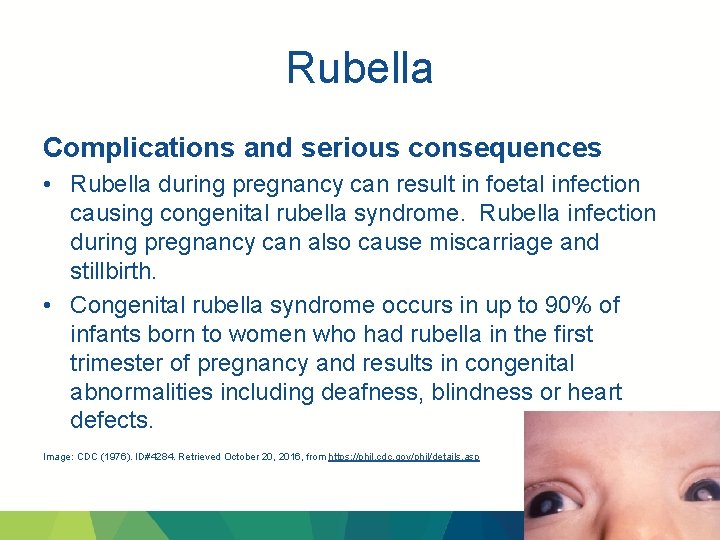 Rubella Complications and serious consequences • Rubella during pregnancy can result in foetal infection