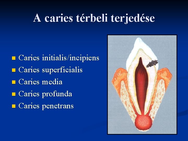 A caries térbeli terjedése Caries initialis/incipiens n Caries superficialis n Caries media n Caries