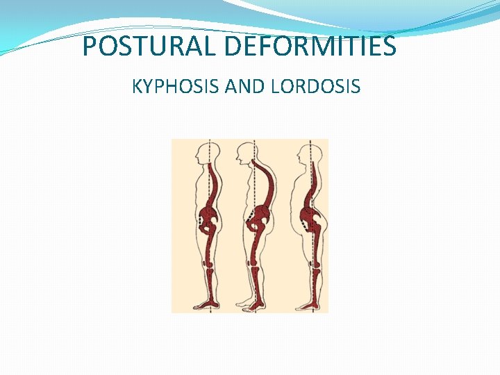 POSTURAL DEFORMITIES KYPHOSIS AND LORDOSIS 