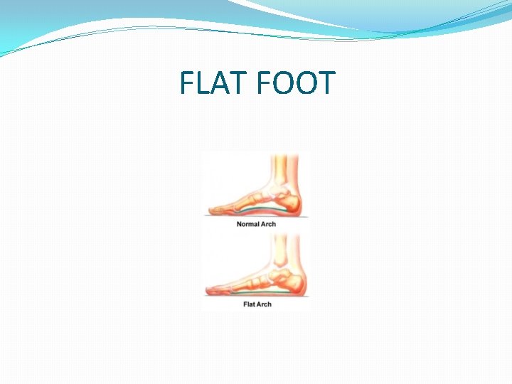 FLAT FOOT 