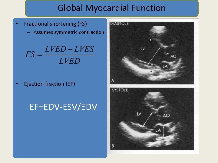 Global Myocardial Function • Fractional shortening (FS) – Assumes symmetric contraction • Ejection fraction