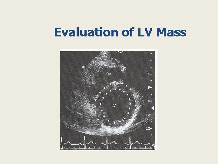 Evaluation of LV Mass 