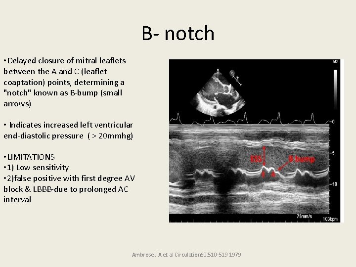 B- notch • Delayed closure of mitral leaflets between the A and C (leaflet