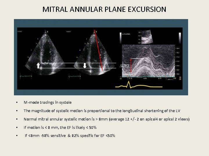 MITRAL ANNULAR PLANE EXCURSION • M-mode tracings in systole • The magnitude of systolic