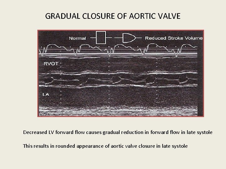 GRADUAL CLOSURE OF AORTIC VALVE Decreased LV forward flow causes gradual reduction in forward