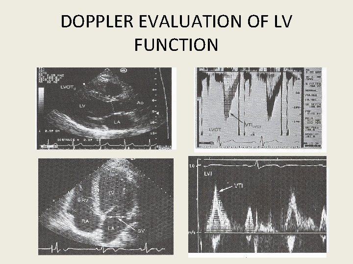 DOPPLER EVALUATION OF LV FUNCTION 