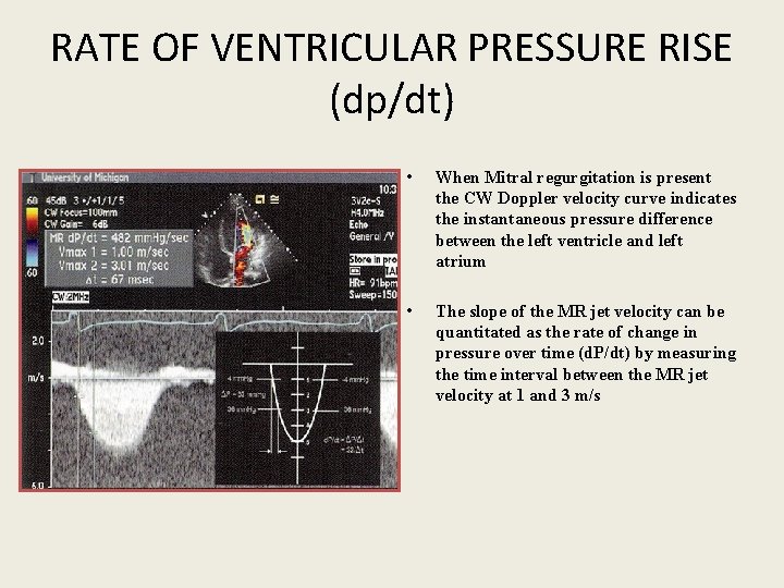 RATE OF VENTRICULAR PRESSURE RISE (dp/dt) • When Mitral regurgitation is present the CW
