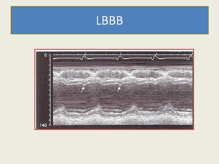 LBBB 