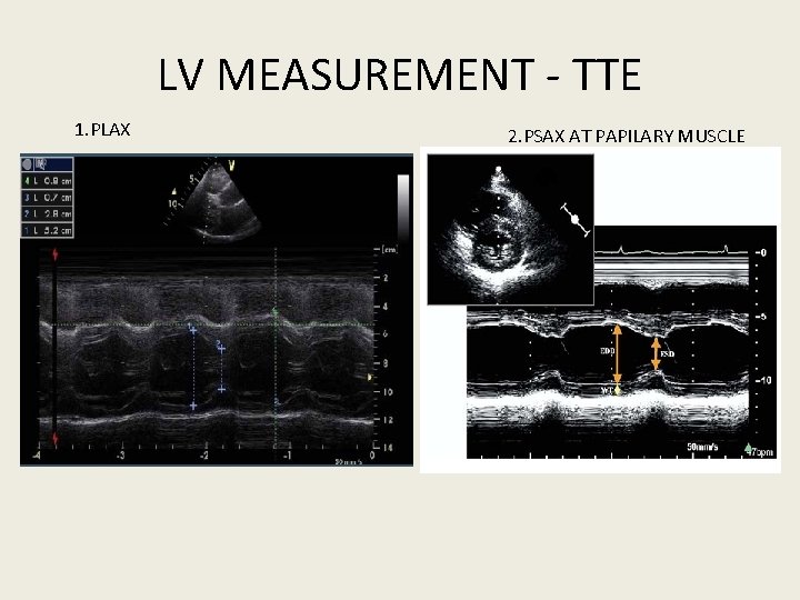LV MEASUREMENT - TTE 1. PLAX 2. PSAX AT PAPILARY MUSCLE 