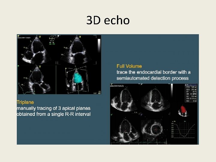 3 D echo 