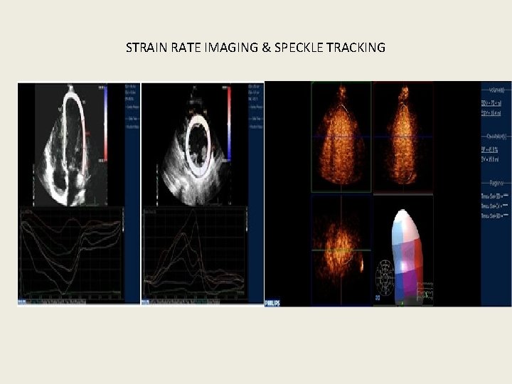 STRAIN RATE IMAGING & SPECKLE TRACKING 