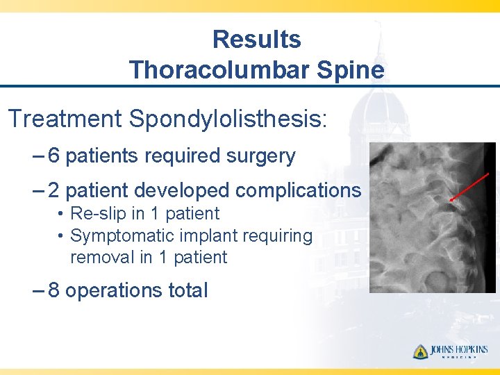 Results Thoracolumbar Spine Treatment Spondylolisthesis: – 6 patients required surgery – 2 patient developed