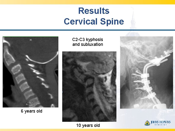 Results Cervical Spine C 2 -C 3 kyphosis and subluxation 6 years old 10