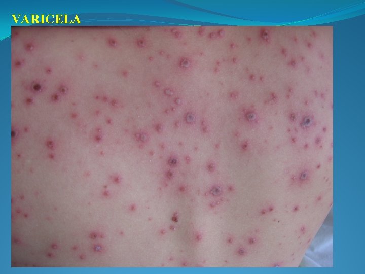 VARICELA 