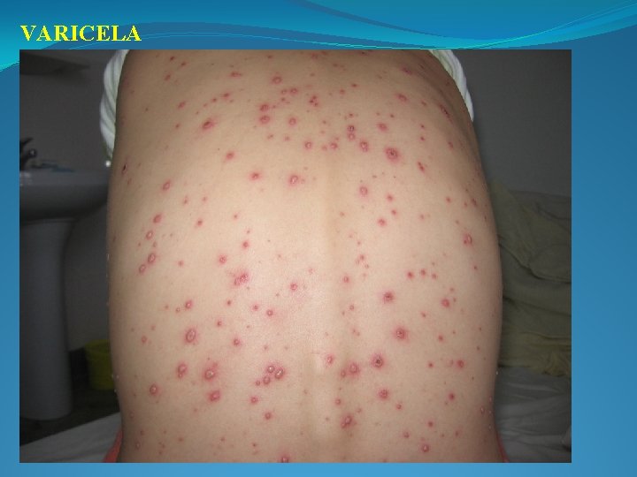 VARICELA 