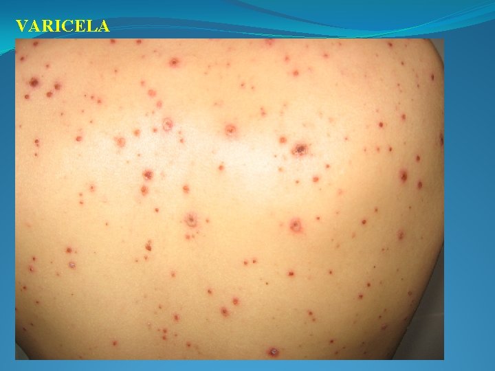 VARICELA 