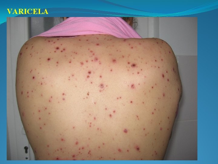 VARICELA 