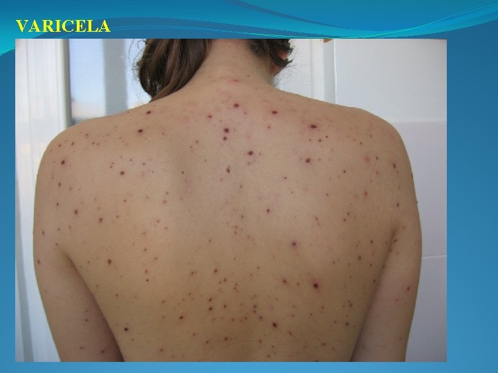 VARICELA 