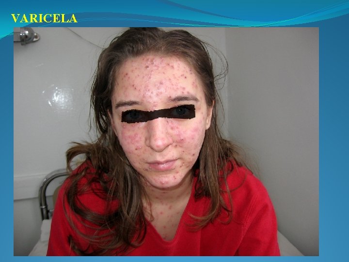 VARICELA 