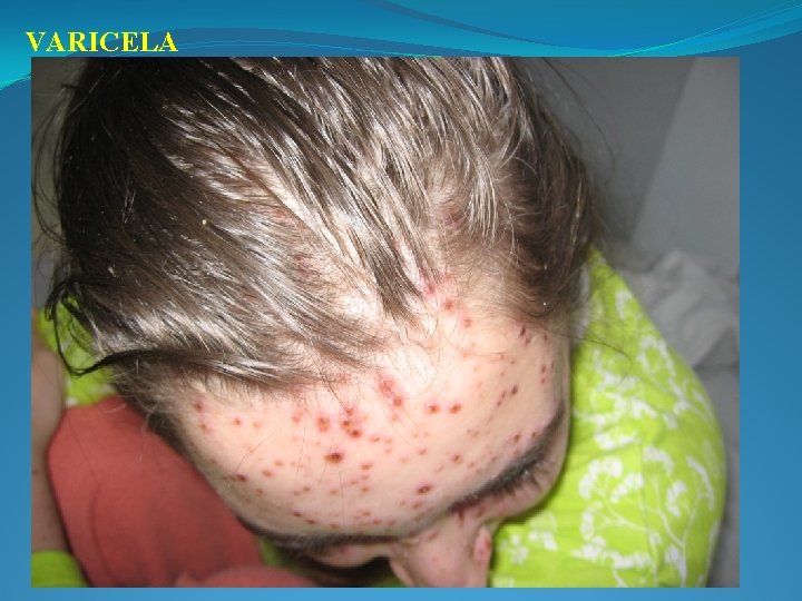 VARICELA 