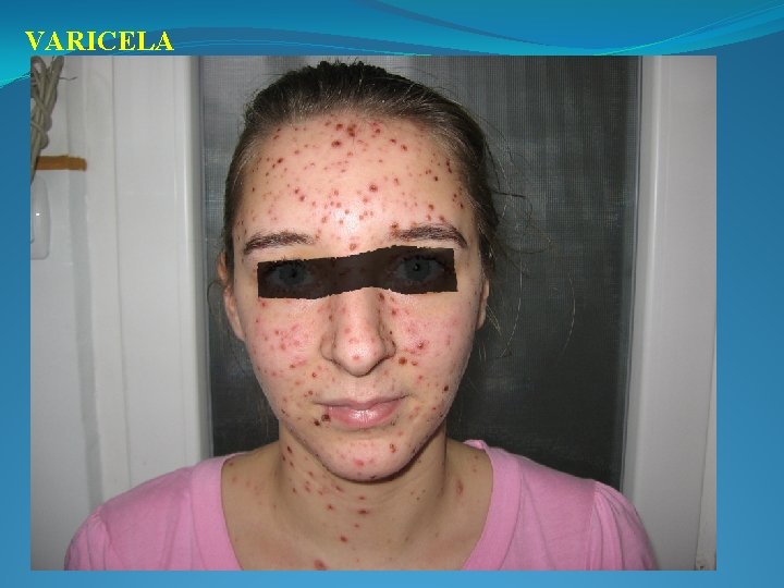 VARICELA 
