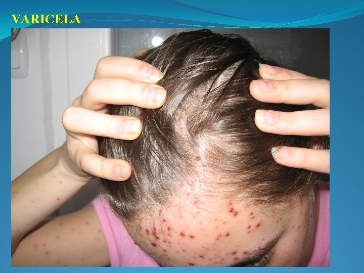 VARICELA 