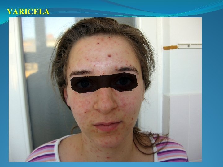 VARICELA 