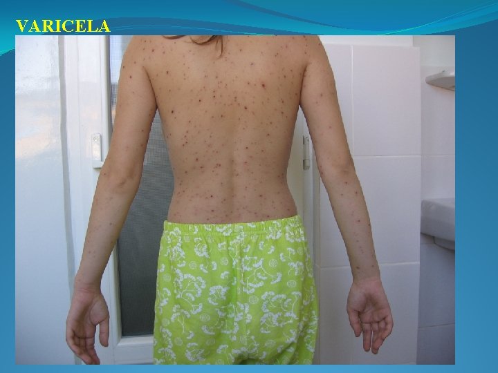 VARICELA 